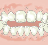前歯が嚙み合わなくなる（開咬）