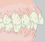 出っ歯（上顎前突）になってしまう