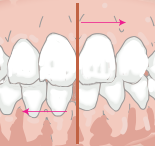 上下の歯の中心がずれてしまう（交叉咬合）