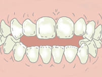 「開咬」とは？