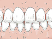 正中離開/空隙歯列とは？