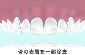 歯の表層を一部除去