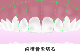 歯槽骨を切る