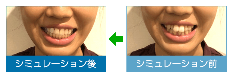 口元の写真 シミュレーション画像